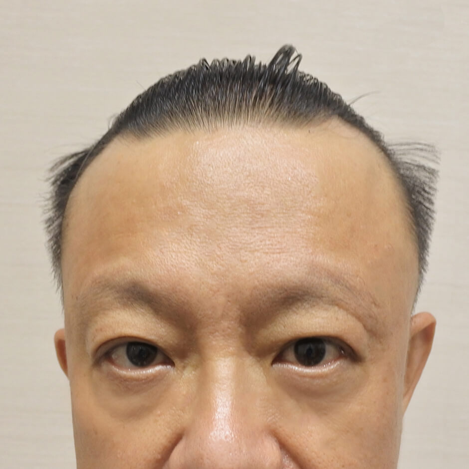 ARTAS 植髮 掉髮 落髮 禿頭